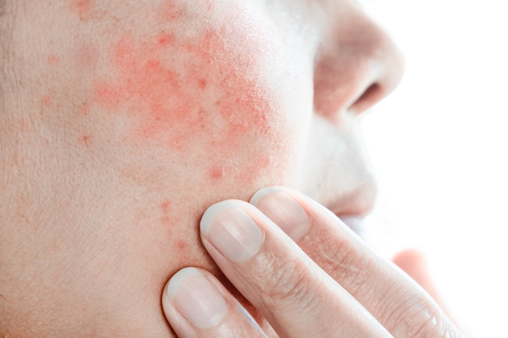 Photo of Laser Burns
